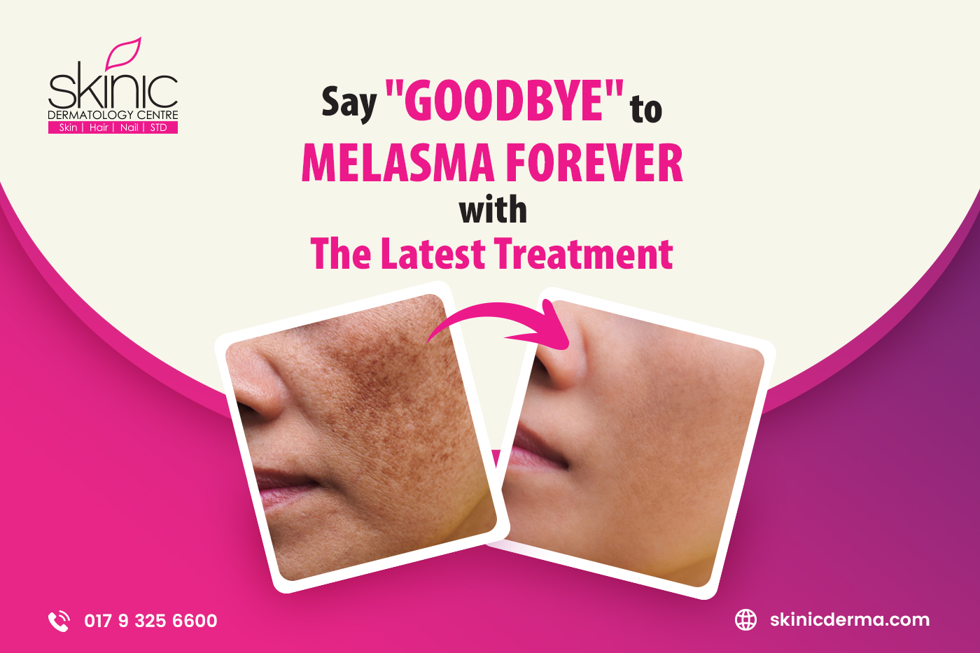 melasma